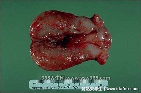 真实掉出来的子宫内膜图片,肉眼看有点像血块/摸有肉肉的感觉