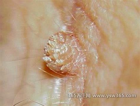 女性真实假疣图片初期图片大全,呈现的症状为鱼状或肉芽状