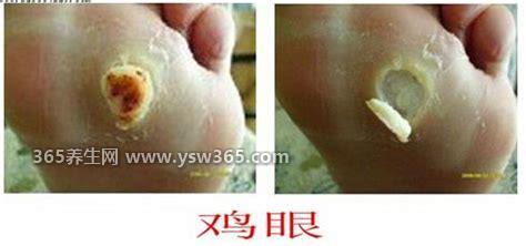 鸡眼挖出来的肉刺图,多见于脚掌前中部/小趾外侧或大趾内缘