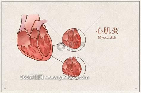 心肌炎的6个危险信号,发热/胸痛/心动过速/胸闷气短等