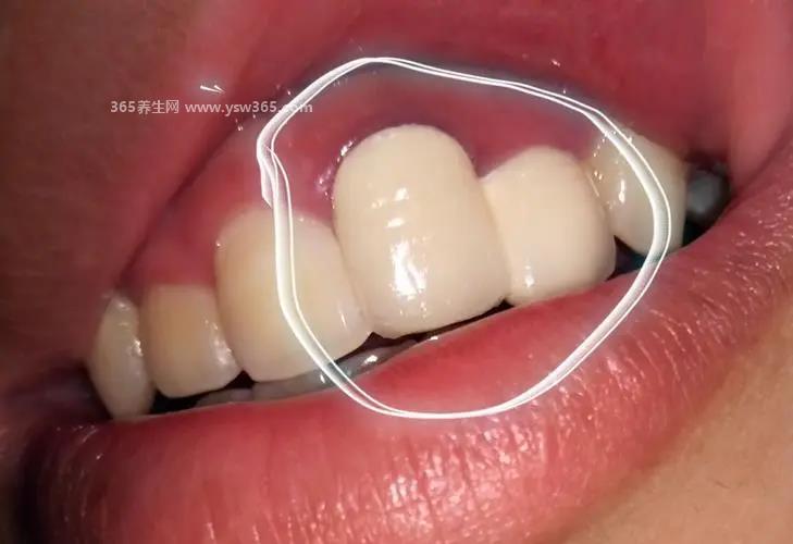 20岁补牙一生要补几次,要看具体情况一般是5-10次