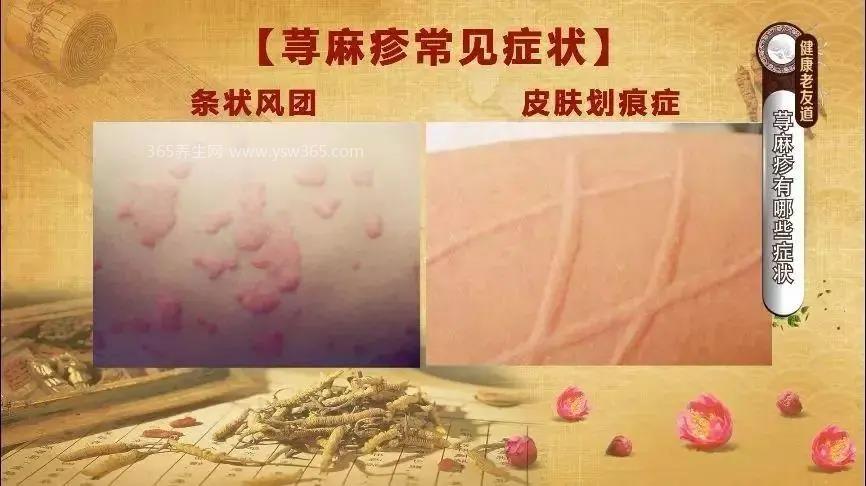 荨麻疹一招永不复发,草药煮沸洗净擦洗患病部位很有效