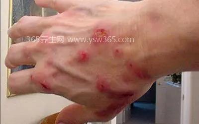 蜱虫咬人后有什么症状图片,会有明显的红肿和呕吐等症状