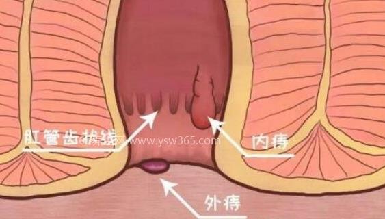肛门外有个肉疙瘩图片,有可能是静脉曲张外痔等症状