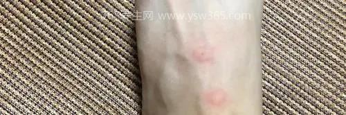 跳蚤咬过后的疙瘩照片,会出现瘙痒/炎症或者水泡