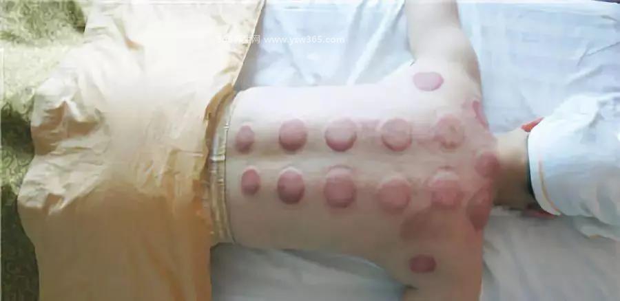 正确背部拔火罐位置图,大椎穴可以清热/解毒/散寒