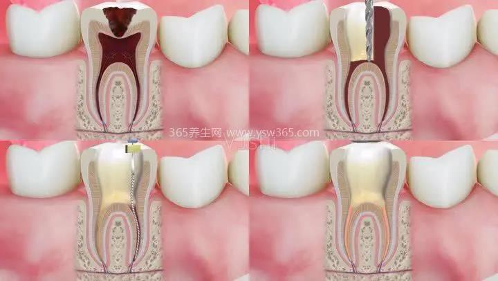 种植牙的五大危害图片,可能导致导致牙龈萎缩,种植牙脱落