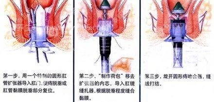 痔疮为什么不建议手术,复发率高还有一定的手术风险