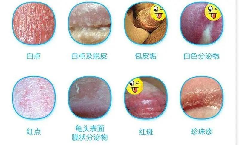 男性龟头炎症状图片怎么样,水肿红斑/糜烂/出血等