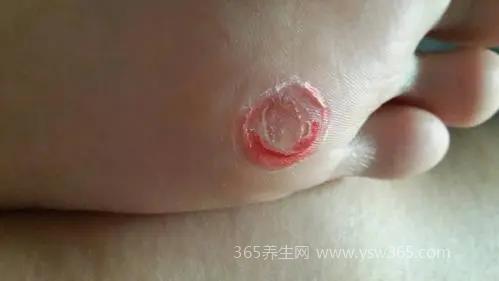 鸡眼自己脱落小妙招,用鸡眼膏涂抹慢慢会自己脱落