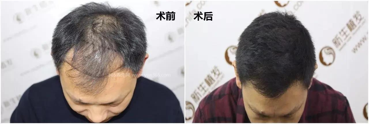 植发要多少钱一般2022,普通的费用一般在12800元左右