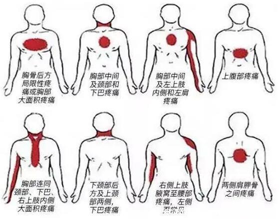 心梗症状前兆9大表现,背痛/牙疼/肠胃不适/失眠等等