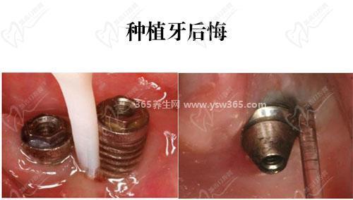 做了种植牙我不想活了,一定要选择正规医院和医生