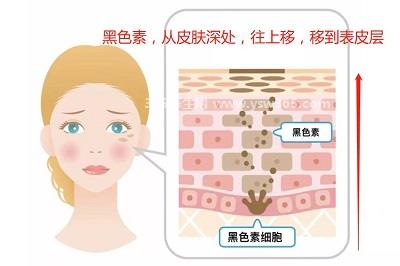 黑色素瘤早期症状图片,会黑色素加深沉着快速生长