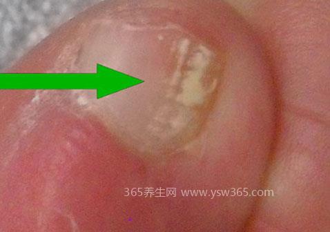白色浅表灰指甲初期症状图片