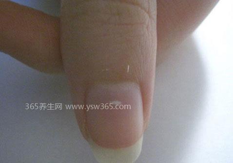 手指甲最轻微的白色浅表灰指甲图片
