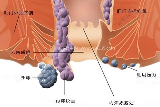 痔疮24种图片