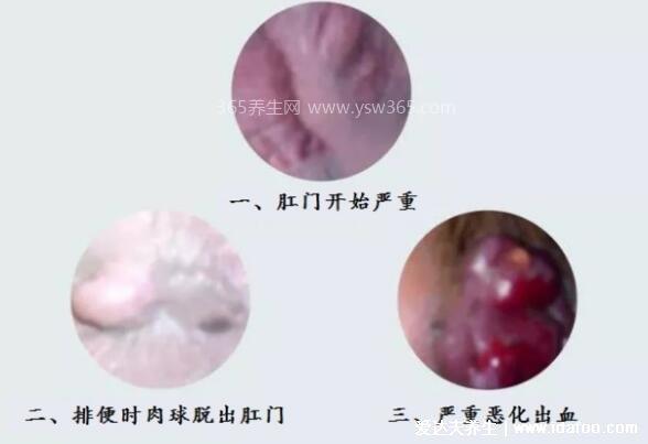 痔疮24种图片