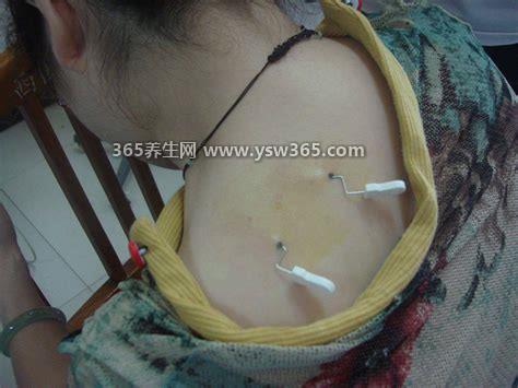 坏死性筋膜炎图片早期症状,发病部位皮肤会红肿呈片状出现