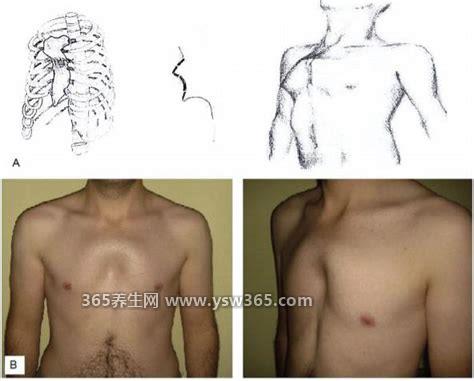 鸡胸和正常人区别图片男,青春期很常见的/不同的外观