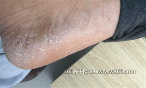 4种不同类型脚气的图片,水泡型脚气刚开始是小水疱壁厚饱满
