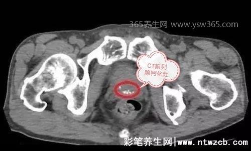 前列腺钙化灶是什么意思,严重会对性功能有直接伤害