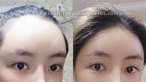 一般做个发际线多少钱,价格差异很大,从几千到几万不等