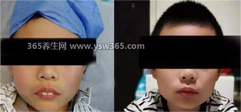 没有切除腺样体后悔到家了,摘除后发现很多问题都治好了