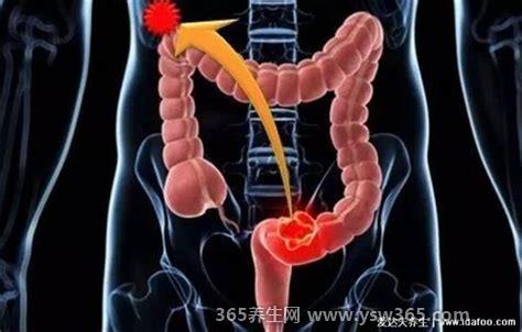 结肠癌的早中晚期的症状和表现,会导致腹泻便秘/一天多次