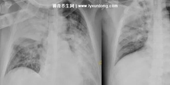 大白肺是新冠吗症状是什么样能活多久,一般三个月左右