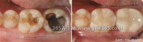 牙齿烂了一个洞很痛怎么办,最好去医院检查拔牙