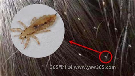 头上的虱子长什么样图片,是一种微小的寄生虫/有锋利的钩子