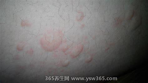 身上起红疙瘩很痒图片,一般是湿疹/荨麻疹/过敏性皮炎引起的