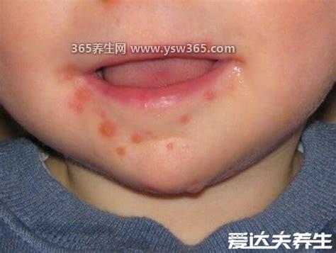 小儿手足口病最早期图片及症状,会有一些皮疹或子孢子