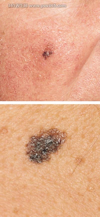早期皮肤癌图片和症状,如果你有边缘不平/表面粗糙可能是皮肤癌