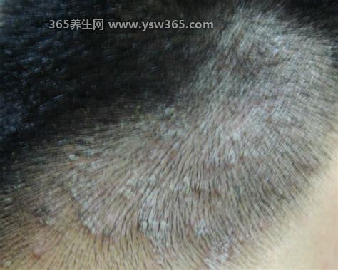 头皮癣症状图片早期图片,黄癣大约有黄豆大小