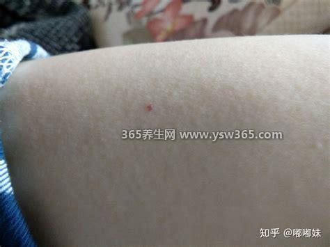朱砂痣长啥样图片,身上的小红血斑像黑痣它就是朱砂痣