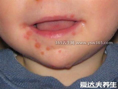 小儿手足口病最早期图片,5岁以下儿童多见/夏秋季多见