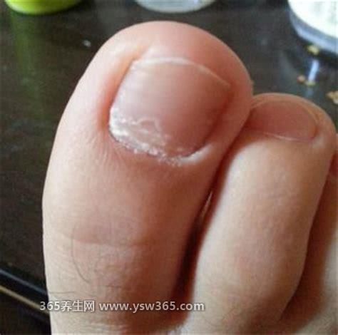 灰指甲初期症状图片及治疗方法,从指甲边缘开始逐渐变黄
