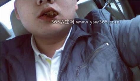 嚼槟榔脸变大怎么恢复,戒了槟榔一段时间就能恢复