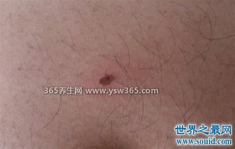 蜱虫咬人后的伤口图,皮肤明显红肿患处会出现炎症