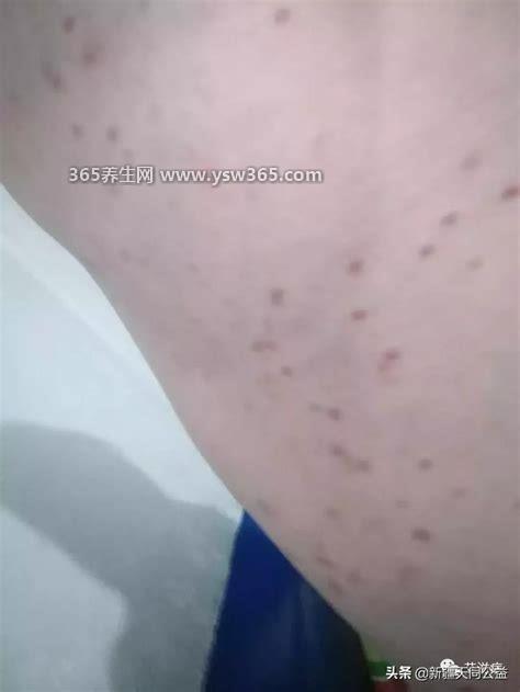艾滋病全身图片症状图片,皮疹的颜色是绛红色或黑色