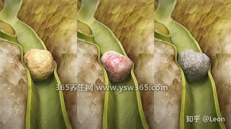 胆结石吃什么可以化掉结石,乌梅/核桃/黑木耳/橙子