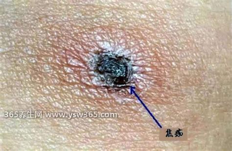真实恙虫病图片症状,会看到一个黑色的痂