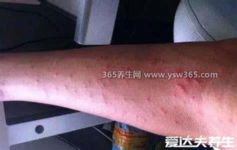 艾滋病初期手上水泡图片,一般在感染后3-4周内出现