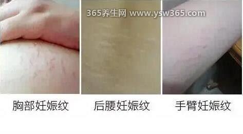 产后真实妊娠纹图片,呈现出像火花一样的粉红色条纹
