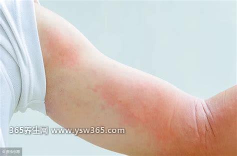 荨麻疹五种食物不能吃,海味(鱼虾蟹贝类)容易诱发疾病