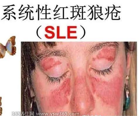 红斑狼疮早期10个征兆图片,会影响多个器官(关节肠胃肾脏等)