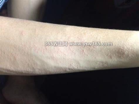艾滋病身上起疙瘩图片,和常见皮肤病上的水泡/丘疹非常相似