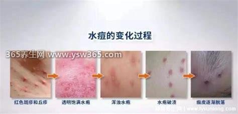 水痘的7天演变过程图片,水痘的整个恢复过程约为21天